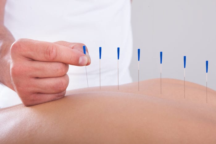akupunktura lajša bolečine