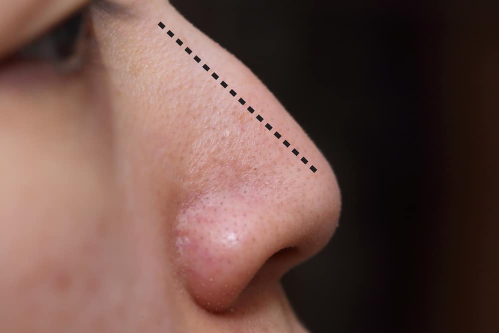 operacija piercinga nosu