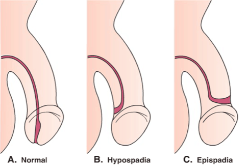luknja v penisu ni normalna, epizode hipospadije