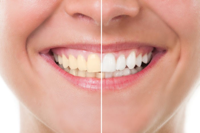 Neželeni učinki beljenja zob z beljenjem