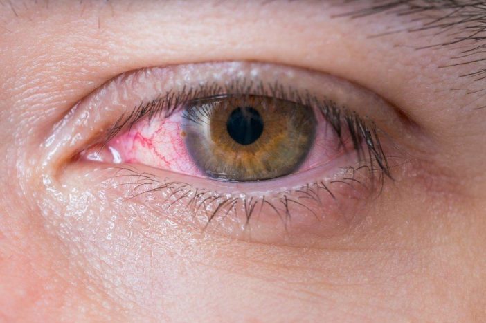 alergijski konjunktivitis rdečih oči