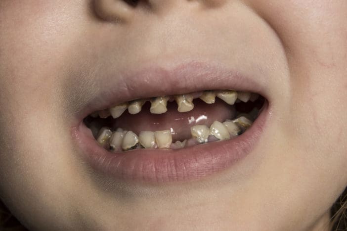razpadanje zob otroške steklenice za razpadanje zob otrok