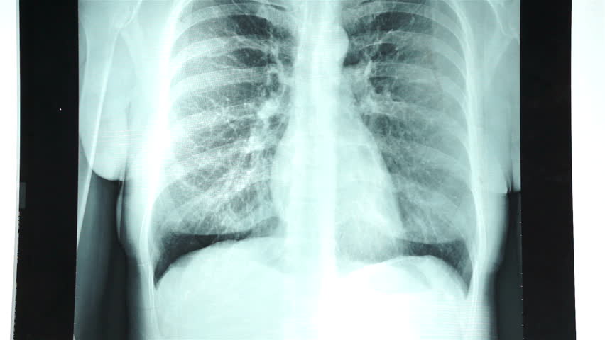 rentgenski pregled prsnega koša