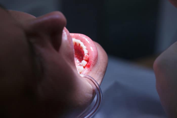 vzrok krvavitve dlesni