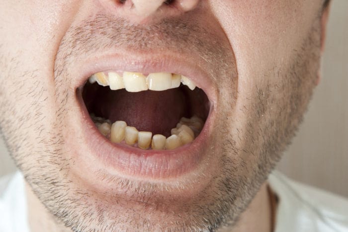 kako preprečiti zobni kamen